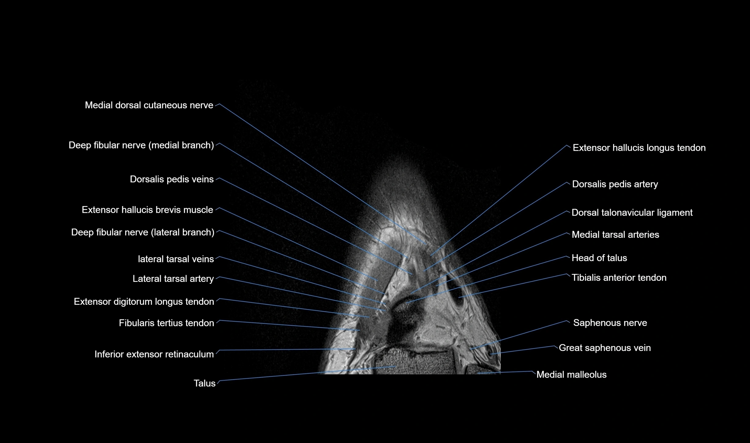 MRI mid foot coronal ligaments cross sectional anatomy 3T  radiology  image-img-00001-00009.webp